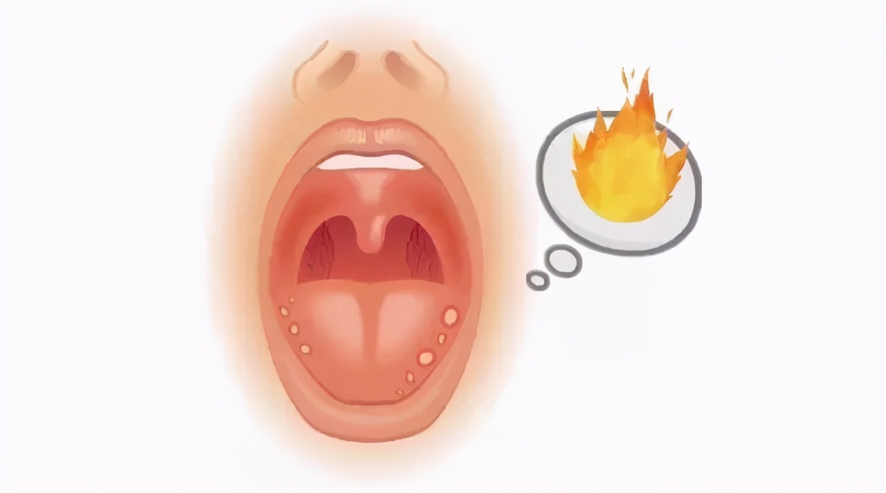 得了口腔溃疡才叫有苦说不出,口腔溃疡的疼是让人纠结的疼