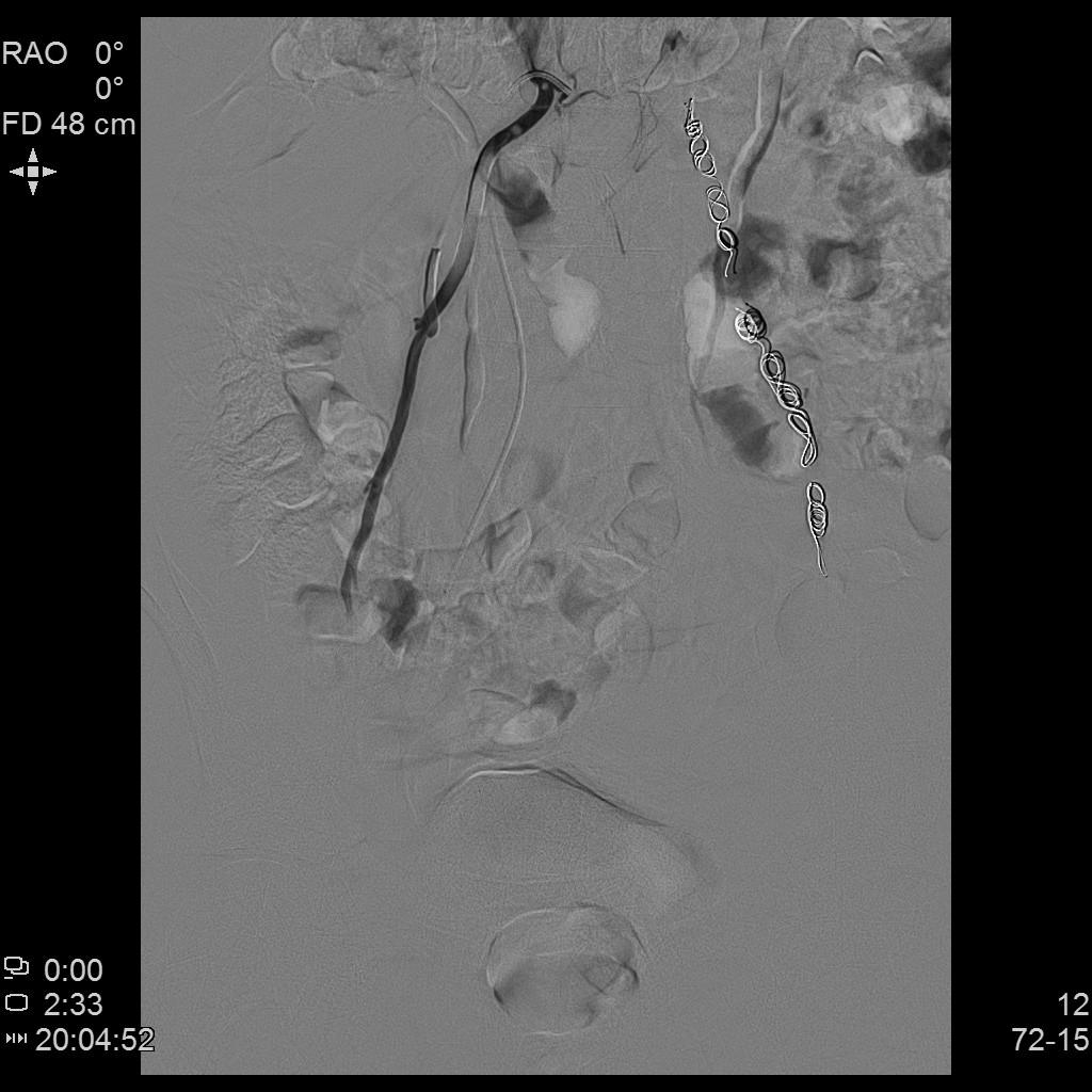 精索静脉曲张介入栓塞死路一条,精索曲张介入栓塞