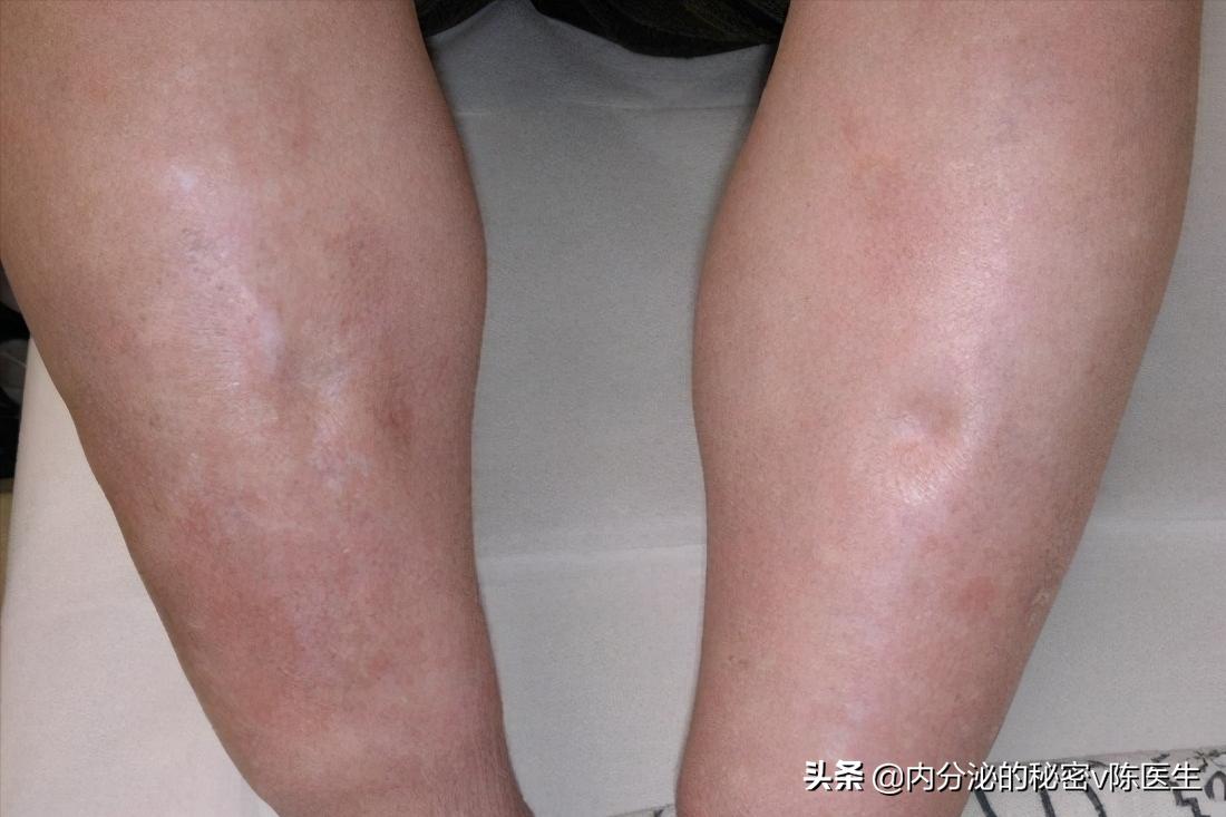 中医如何理解肾与糖尿病,中医治疗糖尿病的再实践再思考