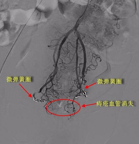 尿血便血同时出现怎么办,便血尿血去看什么科