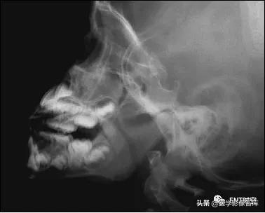 腺样体肥大有必要做x射线复查吗,最简单检测腺样体肥大的方法