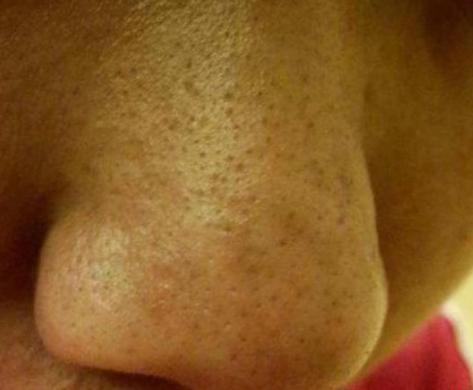 打败毛孔!下一个反孔精英就是你!