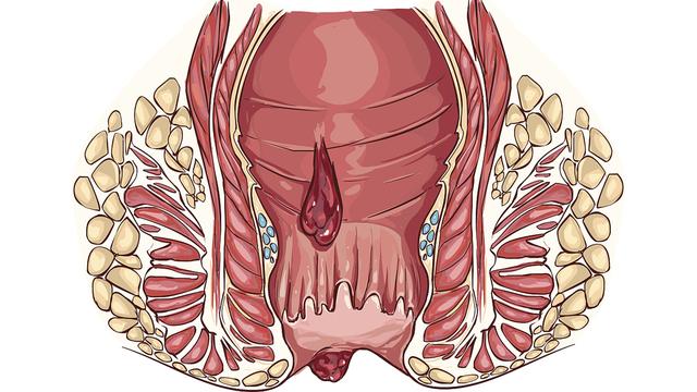 肛周脓肿高发季节,肛周脓肿防止复发饮食注意什么