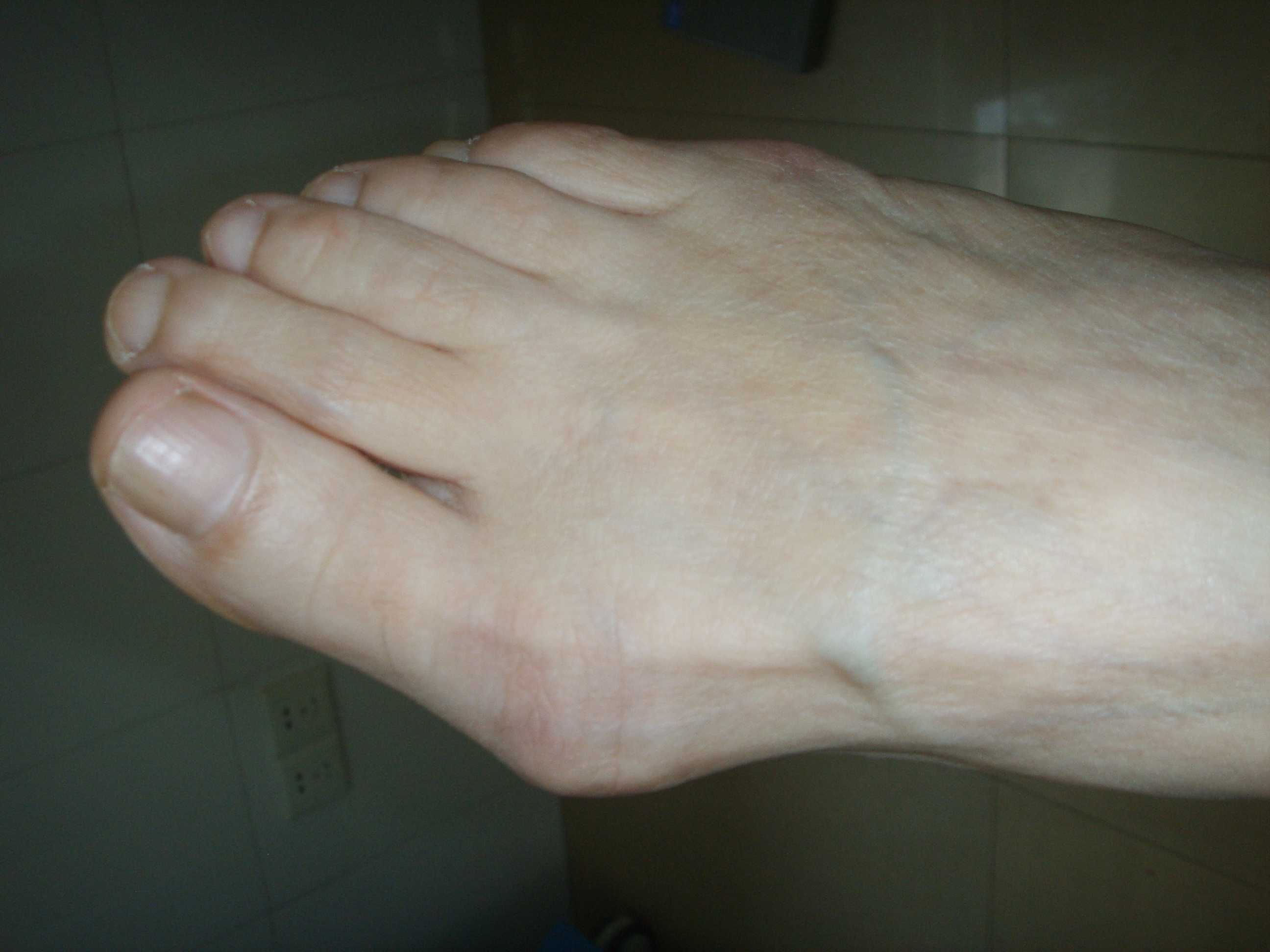 70岁有必要做腰椎手术吗,70岁老人做大脚骨手术可行吗