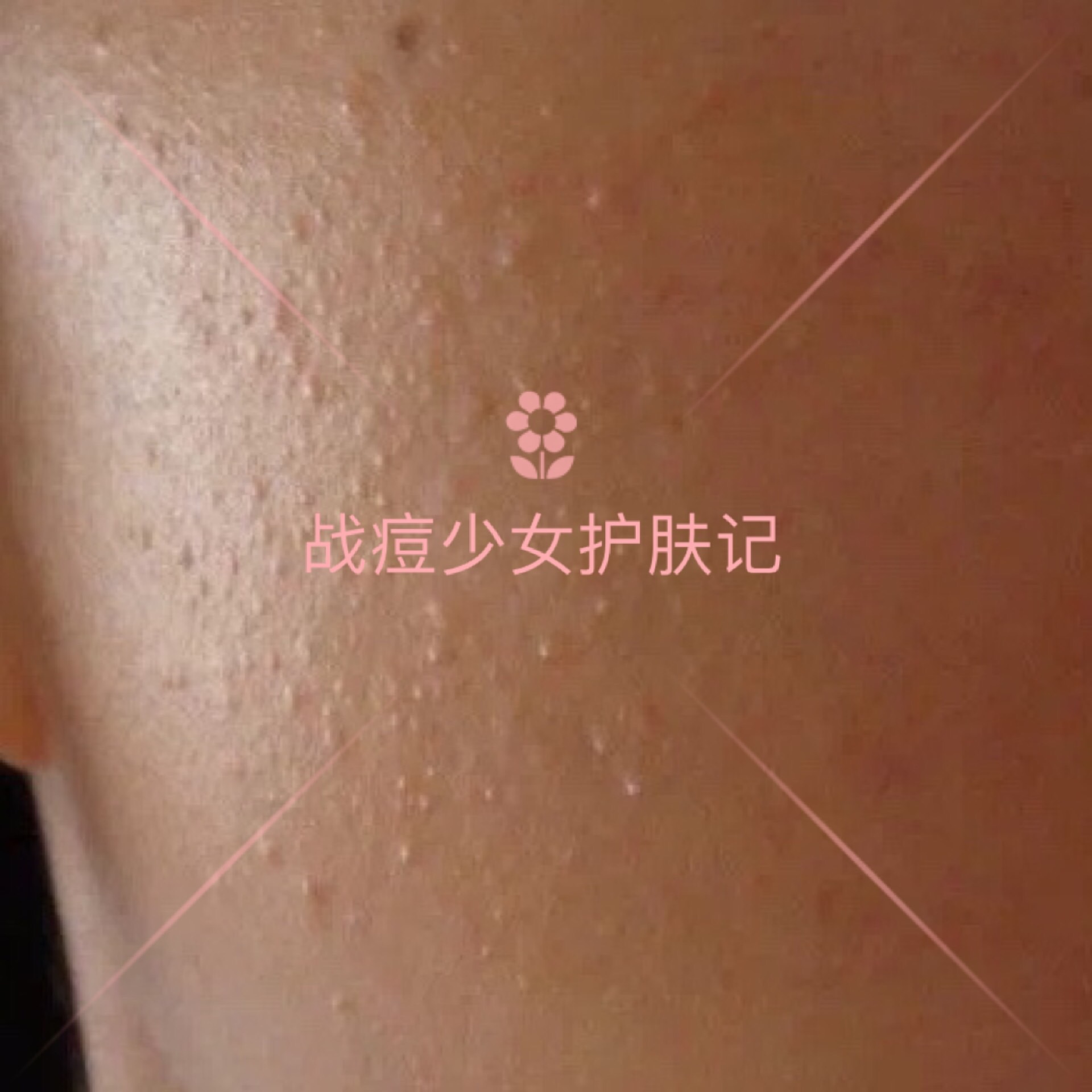 四种痘痘最佳治疗方法,各种痘痘的对症用药