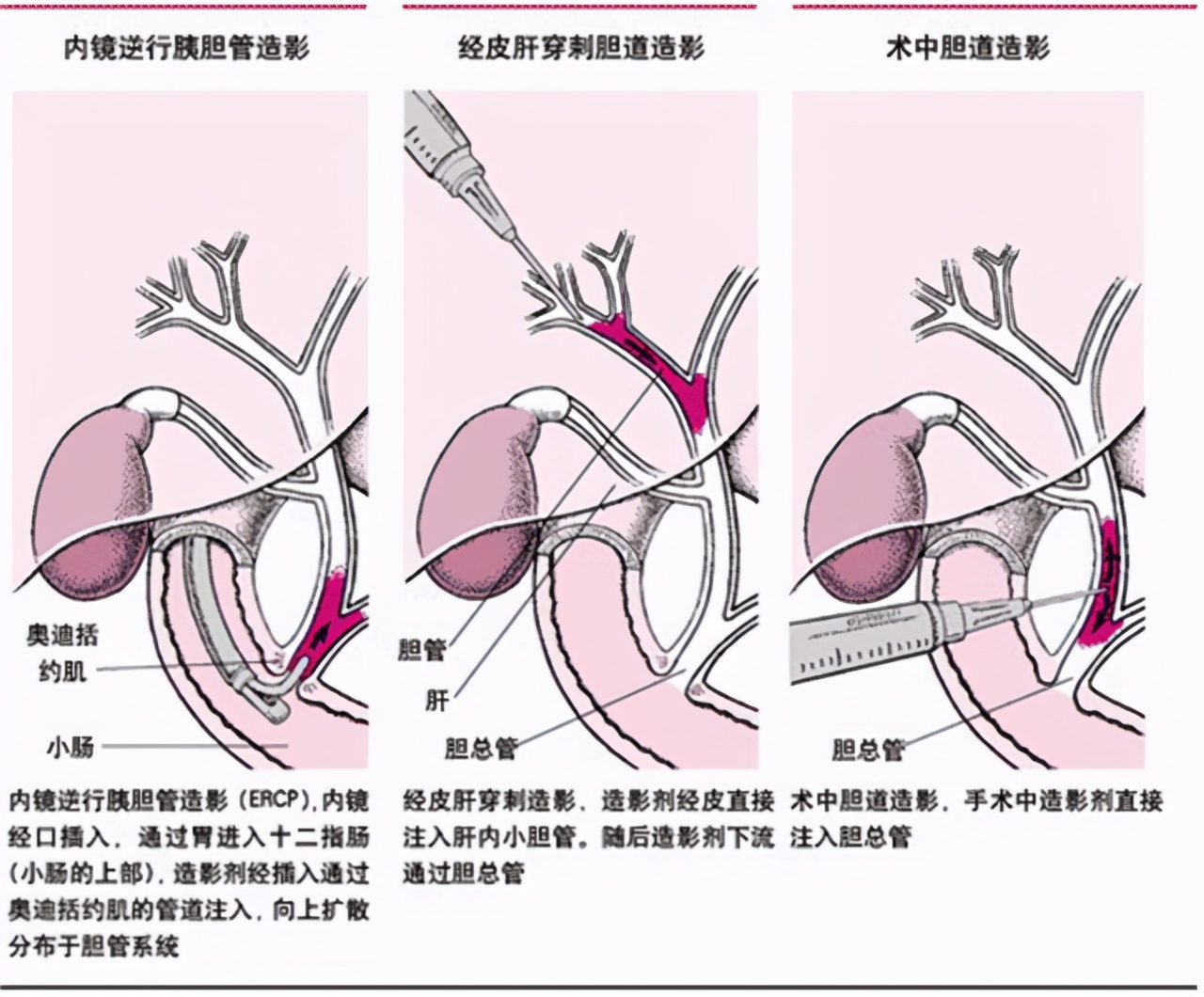胆囊炎引起胃痛多久可以缓解一下,胆囊炎引起胃痛严重吗怎么治疗好