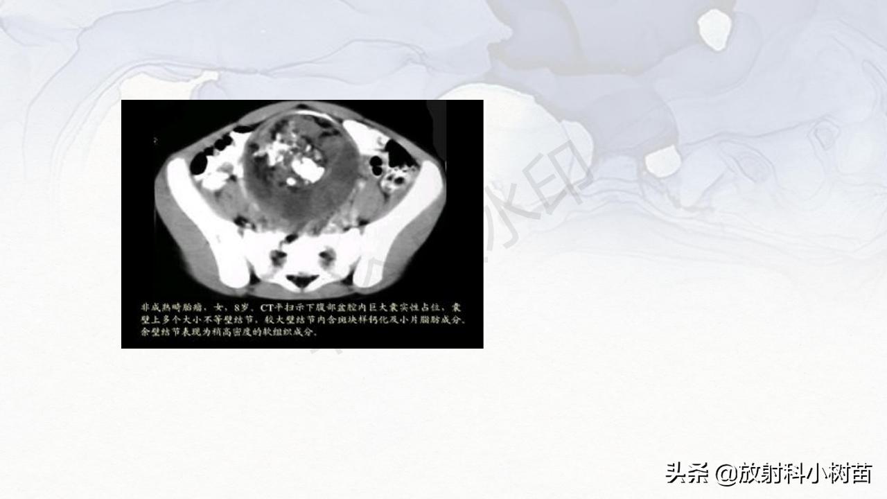 女性盆腔mri解剖图谱,泌尿生殖系统x线解剖