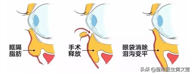 有了泪沟显老怎么办,有没有办法解决后天泪沟