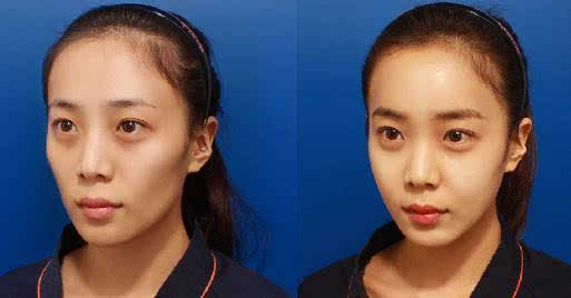 每个月花1000化妆品比不上医美吗？整形医生告诉你事实真相