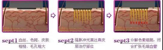 *血丝红**的自救指南，大家快来抄作业