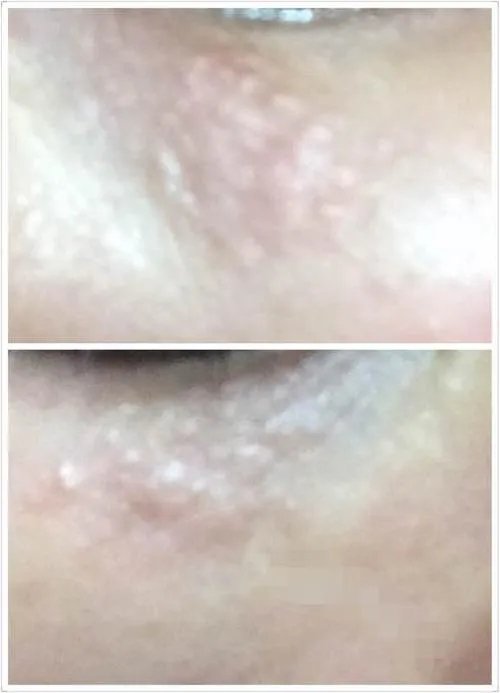 护肤界有名的难缠小妖精，现在搞定它