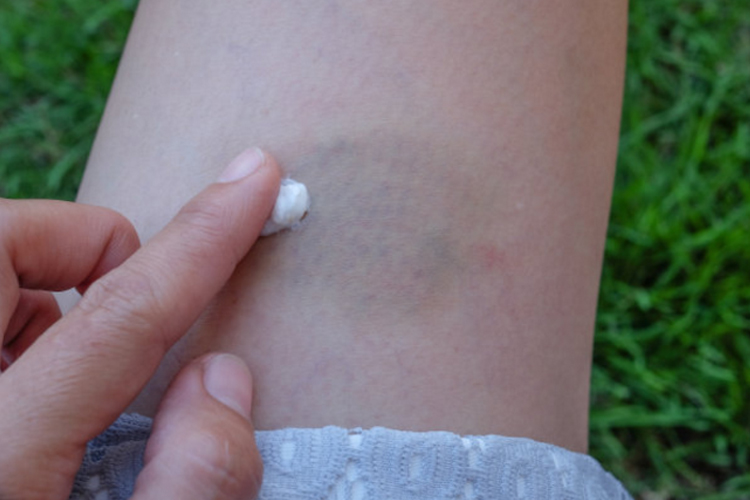 疤痕体质眼睛增生,眼角疤痕增生怎么解决