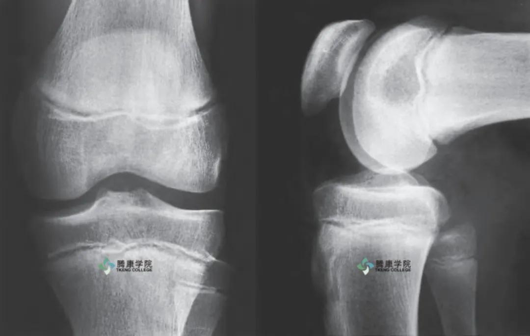 膝关节内侧副韧带解剖,膝关节解剖及常见损伤