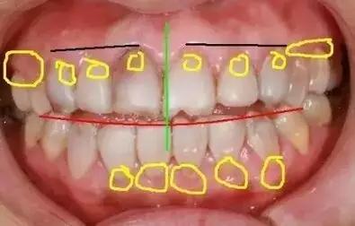 做了烤瓷牙后悔了有补救办法吗,做了烤瓷牙后悔了怎么补救