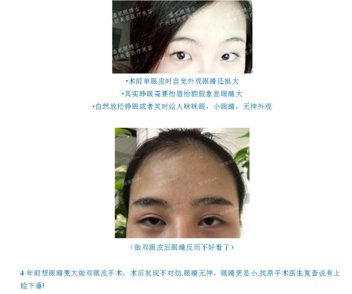 在原有双眼皮的基础上割双眼皮,割双眼皮不知道开扇形还是平行形