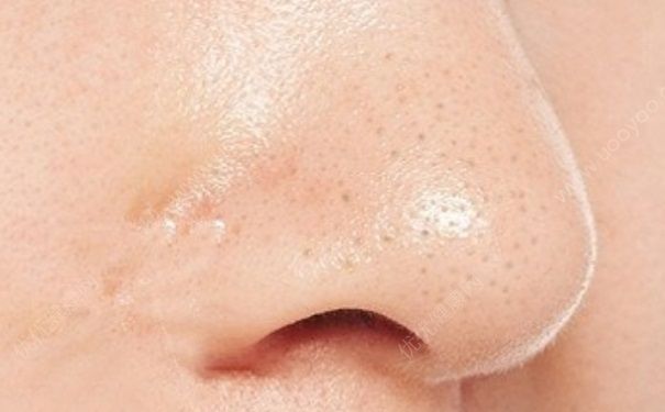 怎么改善毛孔粗大小痘痘,毛孔粗大痘痘改善方法