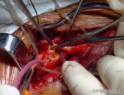 颈动脉有斑块狭窄70%需要怎么治疗,颈动脉斑块狭窄小于50%怎么治疗