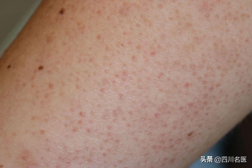 鸡皮肤太丑怎么办啊,鸡皮肤太丑怎么处理好看