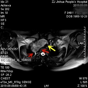 甲状腺肿瘤超大,胸骨后甲状腺肿病情是否很严重
