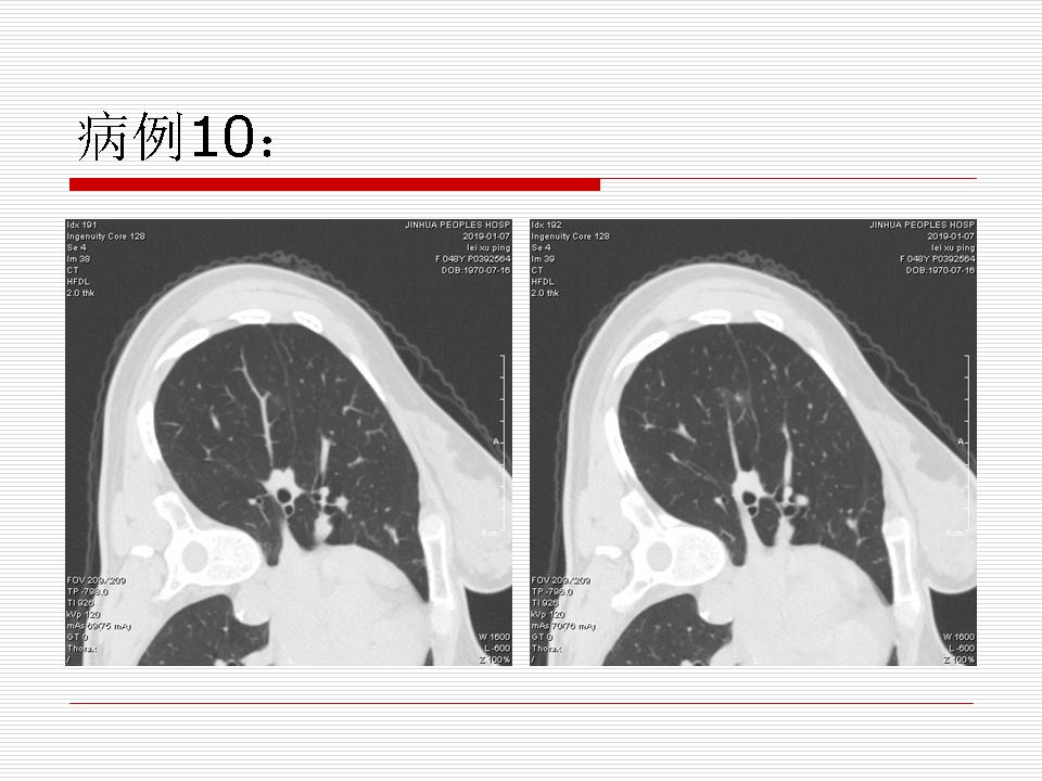 像炎症的肺癌能治好吗,医生说可能是肺癌也可能是炎症