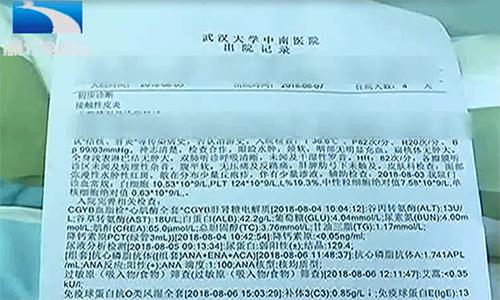 女子贴面膜毁容,女子敷面膜脸部红肿