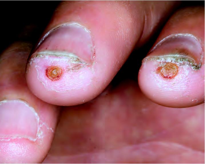 硬皮病是一种什么病,硬皮病由什么造成的