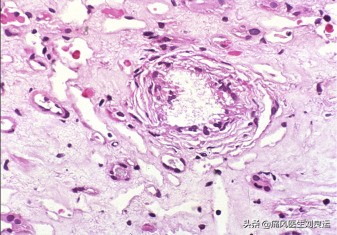 痛风是遗传因素大还是后天因素大,痛风是不是有遗传的因素呀