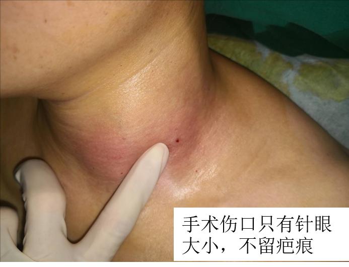 哈尔滨微创消融甲状腺结节哪家好,甲状腺结节微创消融术的过程