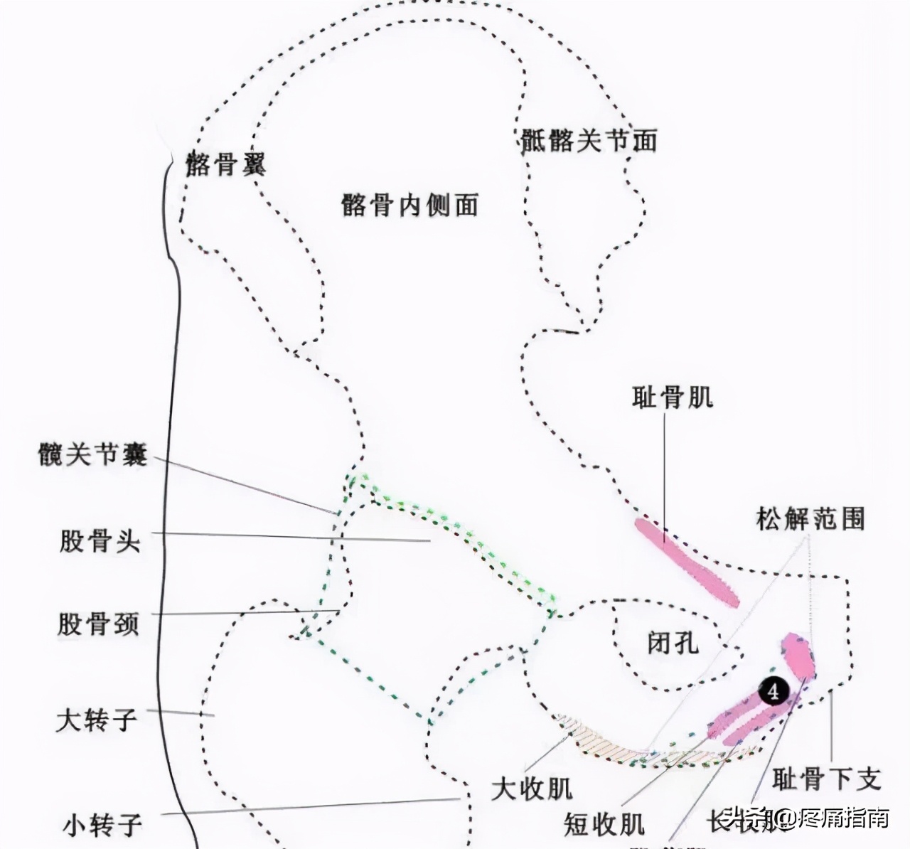 夏天无注射液能治疗骨头坏死吗,骨头坏死用针刀镜有用么