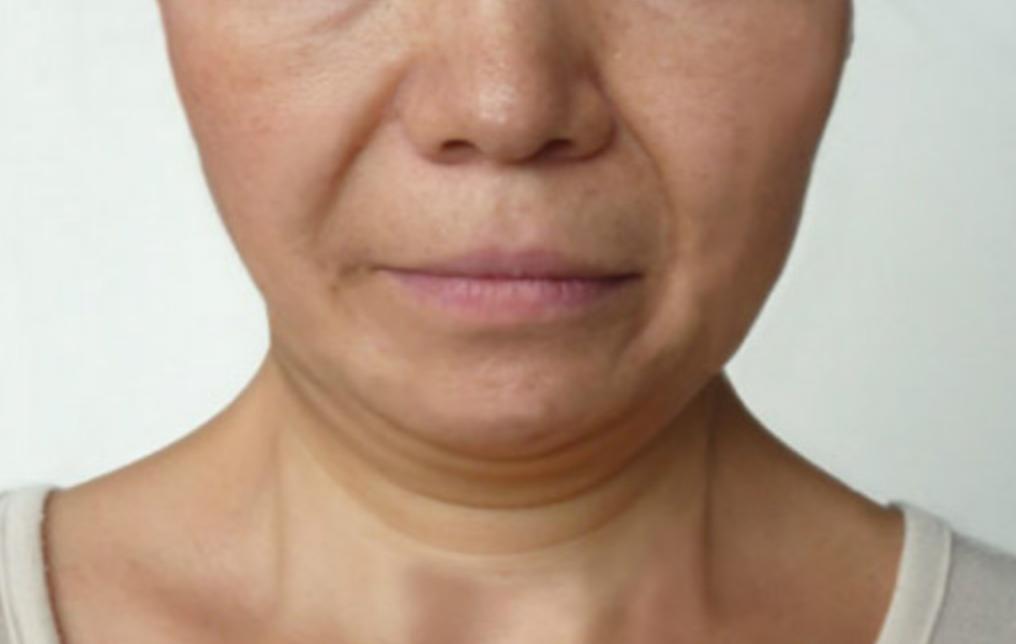 美容面部紧致提拉全过程,怎么做面部提拉改变大小脸