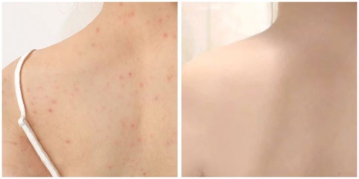 怎么才能彻底让脸上的闭口消失,如何去闭口最有效的方法