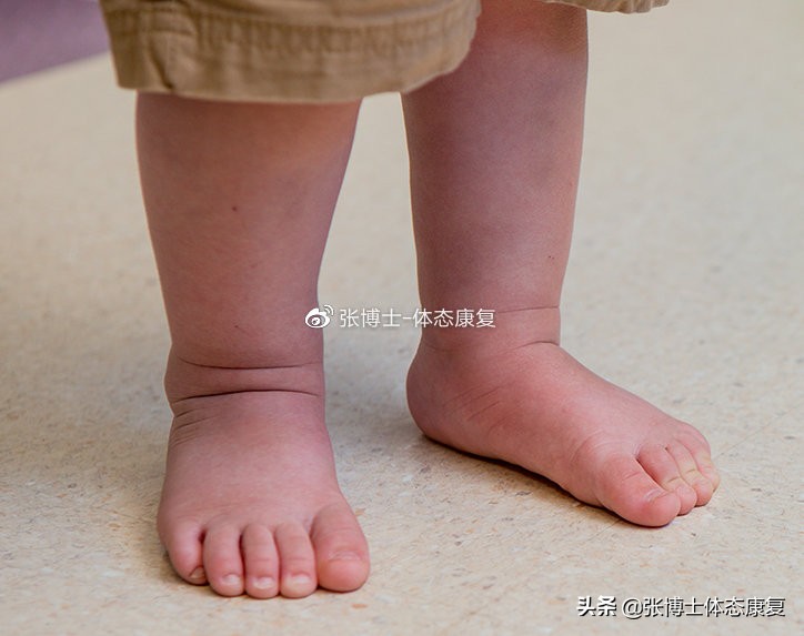 体态畸形怎么矫正,体态矫正腿型修复前景怎样