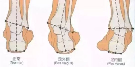 踝关节损伤的论文,浅谈踝关节扭伤的急救措施