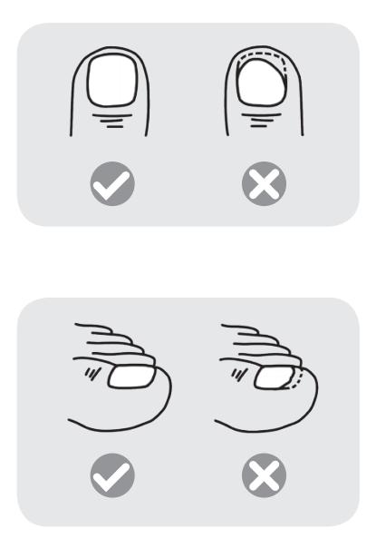 脚指甲剪的过短会得甲沟炎,名医讲堂甲沟炎