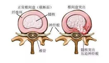 什么是腰椎间盘膨出？很严重吗？