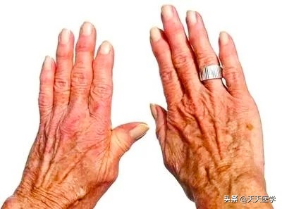 布鲁氏杆菌病的症状及治疗方法,布氏杆菌病的传播途径