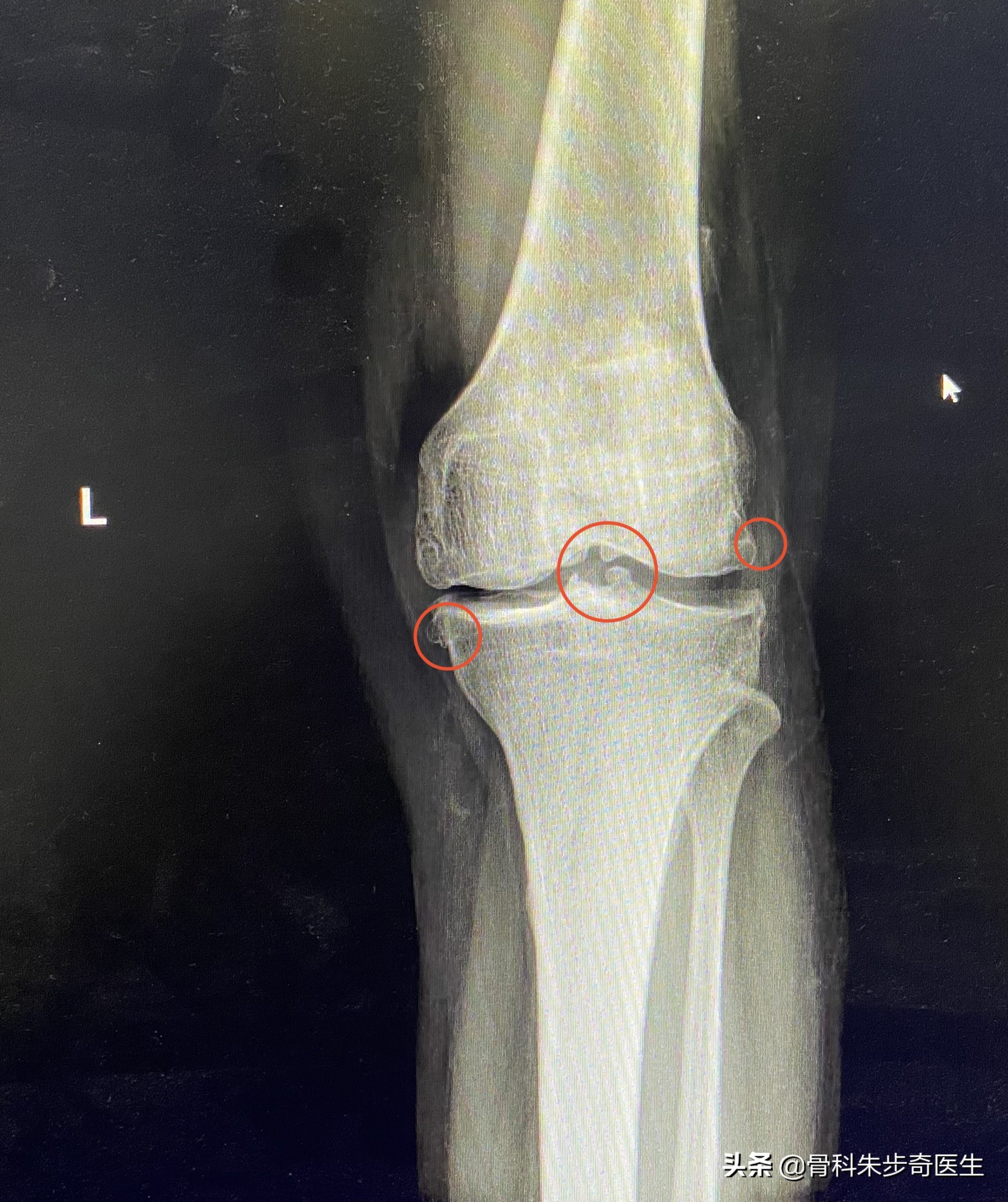 膝关节有骨刺应该怎么治,早期膝关节有骨刺怎么能治愈