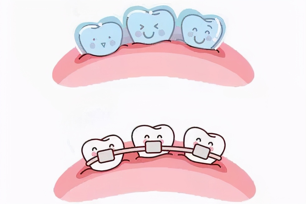 矫正牙多久能戴上牙套,矫正牙需要戴牙套一辈子吗