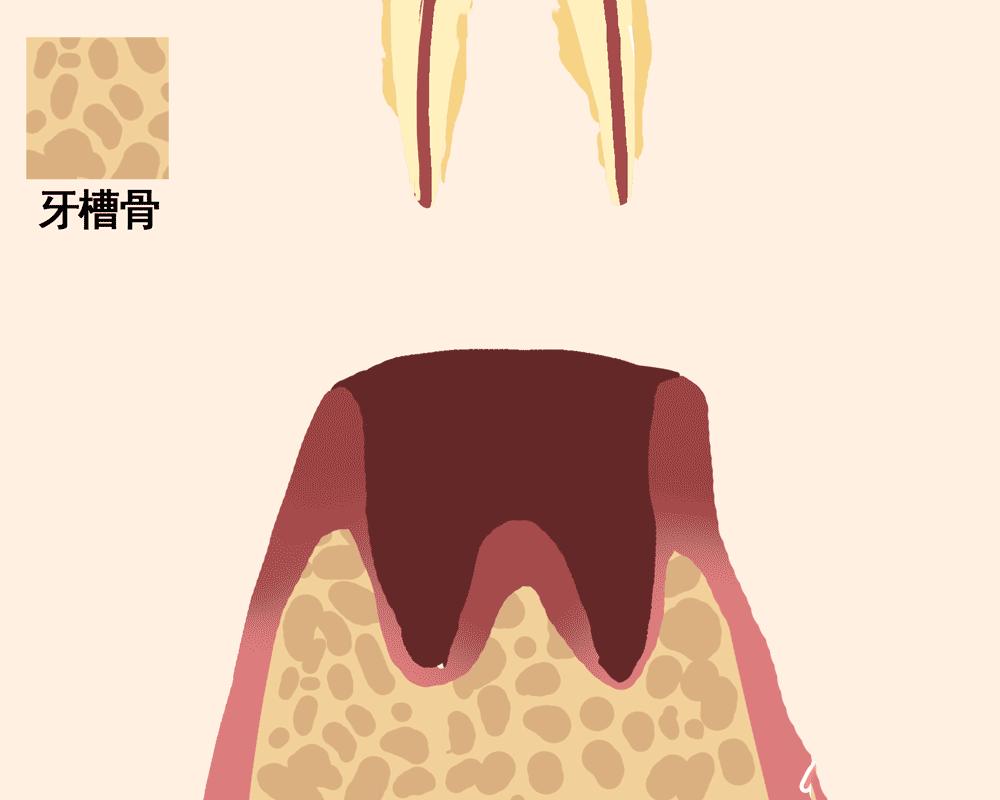 怎样取下一颗牙齿,快要脱落的牙齿怎么拯救