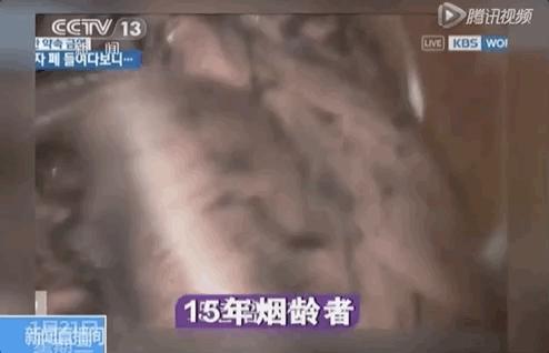 打开死者的肺,才明白有3亿人,在悄悄花钱买死