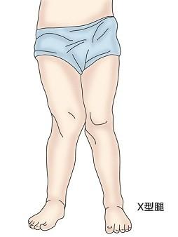 儿童膝内翻去哪里治疗,膝内翻如何矫正儿童