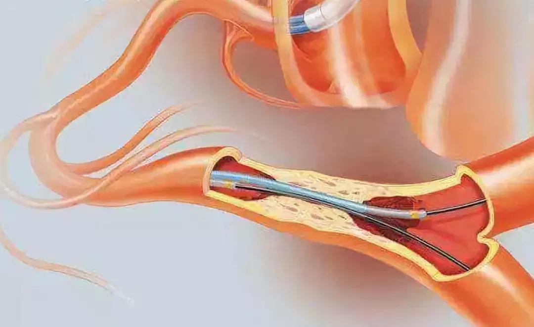 肝癌止疼一次打两针可以吗,肝癌晚期一针见效