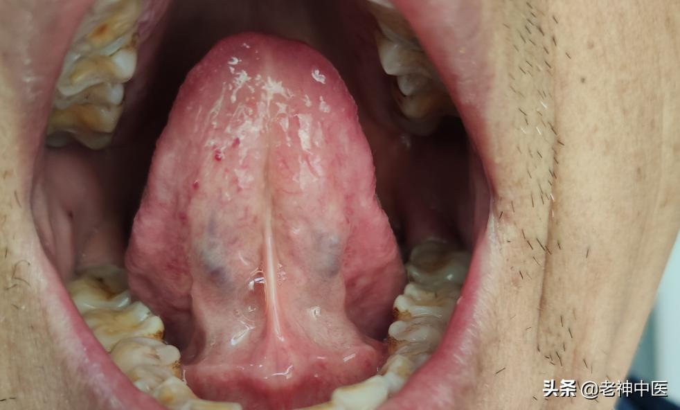 幽门螺旋杆菌胃炎正确的用药方式,幽门螺杆菌萎缩性胃炎的经方治疗