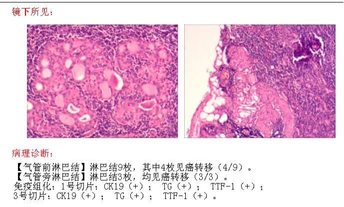 甲癌申报慢性病还是特殊病,甲癌要做免疫治疗吗