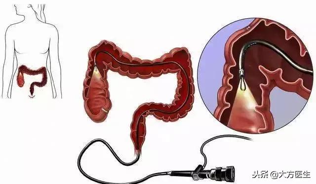 胃复春对肠息肉有治疗效果吗,家族性肠息肉病首选的治疗方式