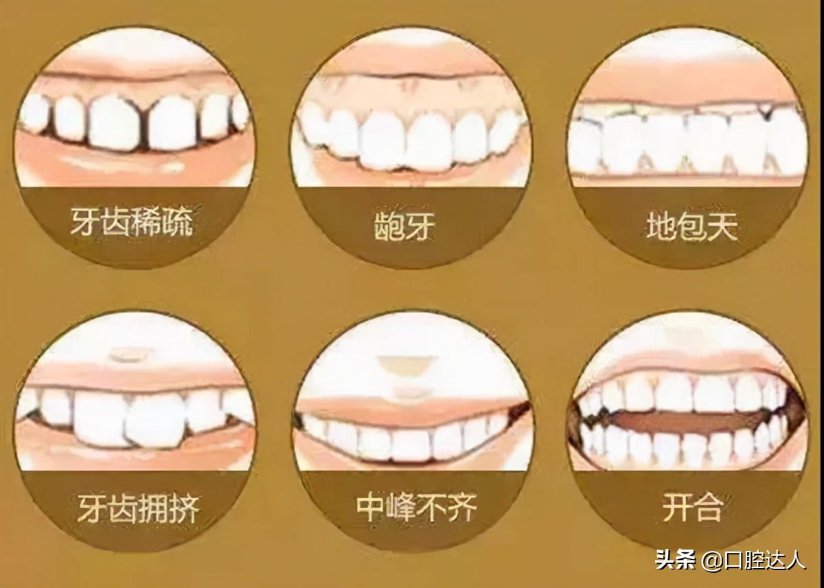 牙齿松动怎么办还能矫正吗,五十左右牙齿松动掉落说明啥