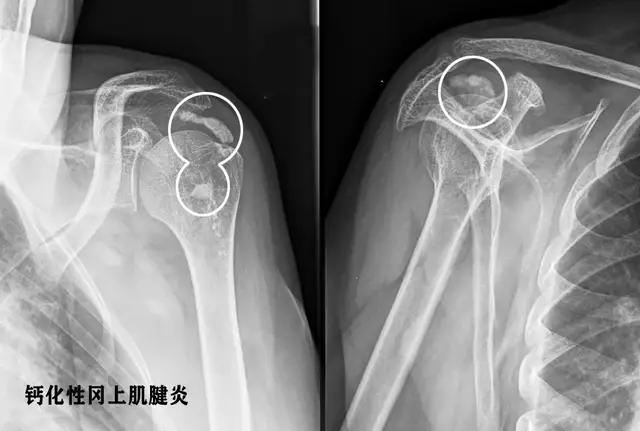 肩膀疼痛要警惕的三种病怎么治疗,肩膀疼痛要警惕的病怎么治疗