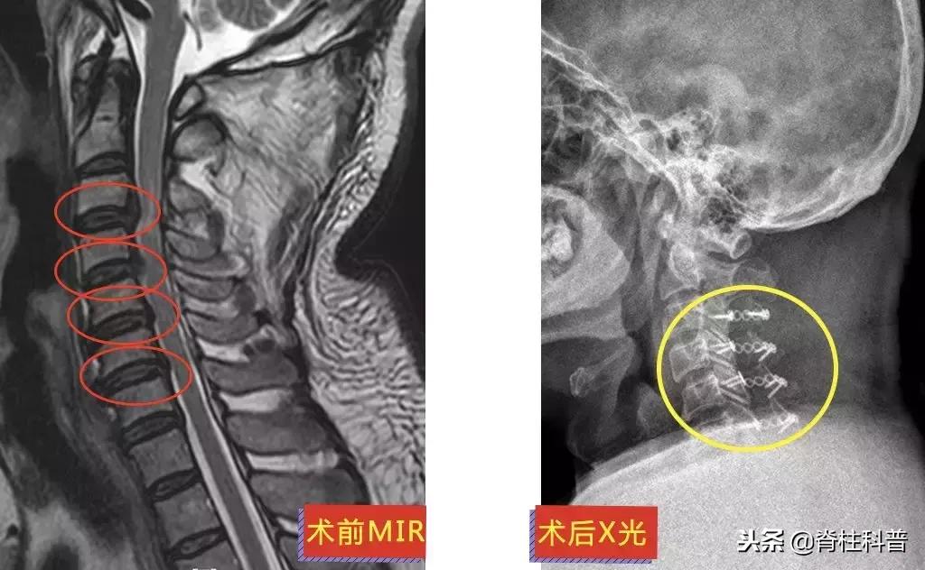 颈椎病治疗的分享,关于颈椎病通俗易懂的科普