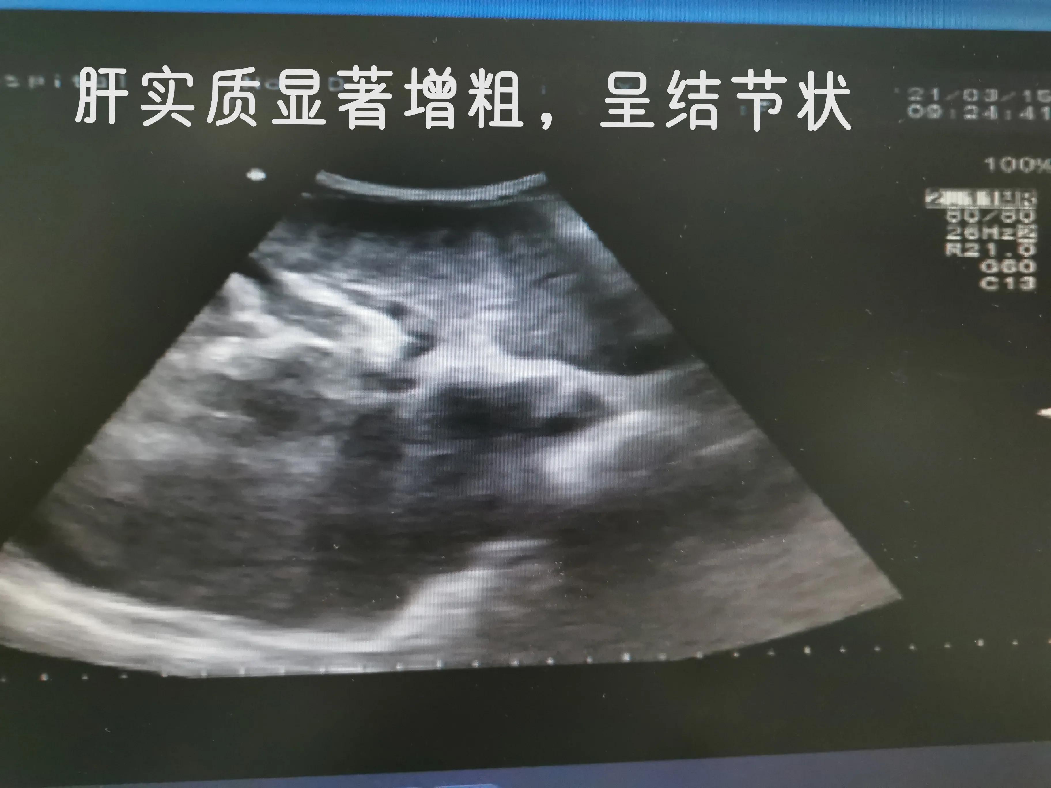 乙肝肝硬化和丙肝肝硬化的区别,乙肝肝硬化肝部占位是肝癌吗