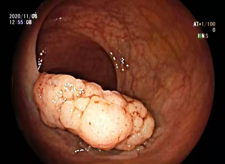 大同守佳消化病医院消化内科，行内镜黏膜下剥离术，成功切除4厘米早期直肠癌